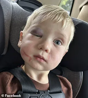 Daycare Worker Accused of Assaulting 1-Year-Old, Leaving Child with Black Eye, Facial Scratches, and Neck Wounds
