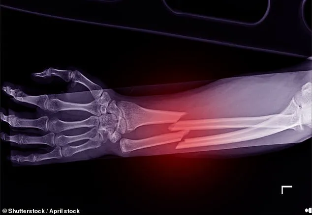 Urgent Warnings Over Delayed Osteoporosis Screening Rollout as Experts Warn of Preventable Deaths