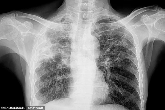 Public Health Officials Address Tuberculosis Case at Leesville High School Amid Broader U.S. Trend