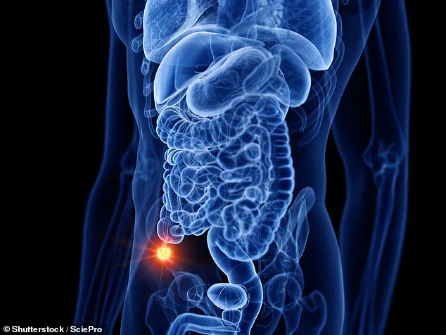 Mystery Deepens as Appendix Cancer Rates Triple in Under-50s, Study Reveals Unexplained Surge