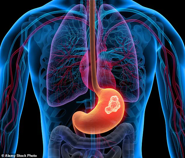 Public Health Alert: Indigestion as a Potential Sign of Serious Heart Conditions, Emphasizing the Need for Prompt Medical Evaluation Based on Expert Advisories