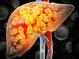 Silent Epidemic: 80-100 Million Americans May Have Undiagnosed Fatty Liver Disease, Says Dr. Jane Smith, Hepatology Expert