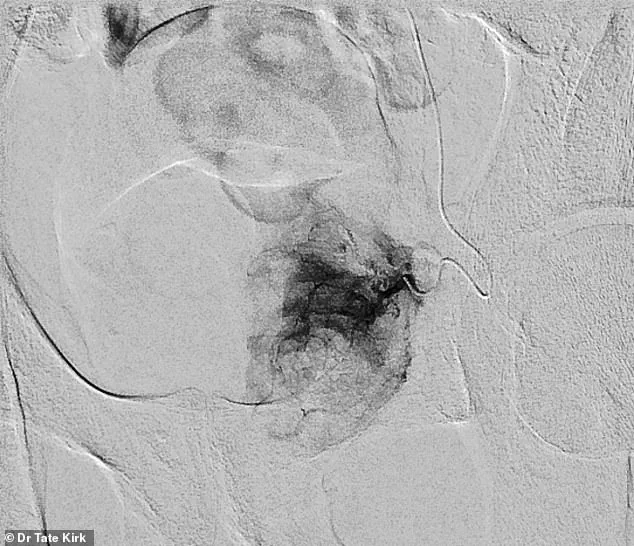 The Growing Burden of Benign Prostatic Hyperplasia: A Health Challenge for Aging Men in the U.S.