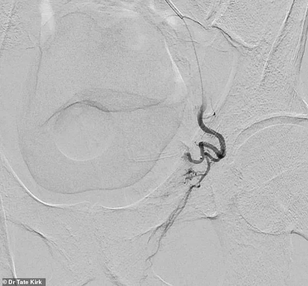 The Growing Burden of Benign Prostatic Hyperplasia: A Health Challenge for Aging Men in the U.S.