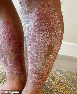 Chad Mendes' Journey to Health: How the Carnivore Diet Transformed His Life and Battle with Psoriasis