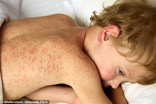 Measles Resurgence Sparks Public Health Alerts at Major U.S. Airports