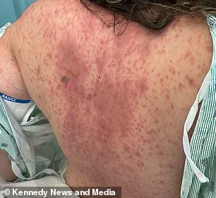 A 1-in-2,500 Chance: The Rare Reaction That Left Emily McAllister Blind and Scarred