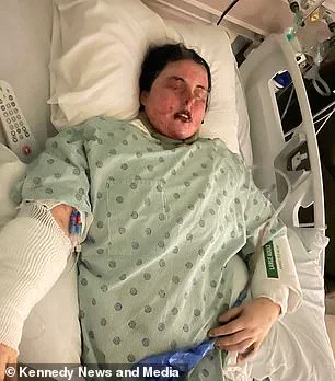 A 1-in-2,500 Chance: The Rare Reaction That Left Emily McAllister Blind and Scarred