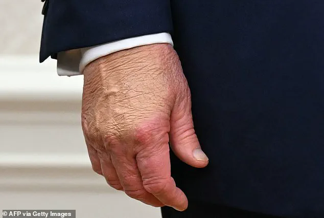 White House Explains Trump's Bruised Hand: 'Hit His Hand' on Signing Table at Davos Event, Says Press Secretary
