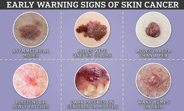 Hidden Threat: Melanoma in the Eyes and the Imperative for Comprehensive Screening and Expert Awareness