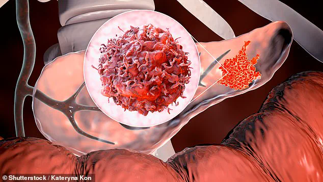 Breakthrough Blood Test for Early Pancreatic Cancer Detection Developed by University of Pennsylvania and Mayo Clinic Researchers