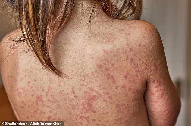 Trump Administration Urges Measles Vaccination as South Carolina Battles Historic Outbreak, Officials Warn of 95% Herd Immunity Threshold