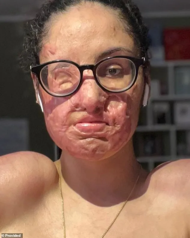 Brooklyn Man Finally Faces Justice Five Years After Brutal Acid Attack