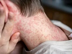 CDC Issues Urgent Travel Advisory as Chikungunya Spreads Across Americas and Beyond