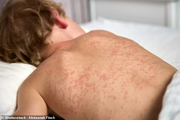 Measles Exposure at Highland High School Sparks Health Alert Over Unvaccinated Student