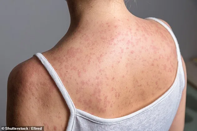 Drug-Resistant XDR Typhi Resurgence Threatens Modern Medicine