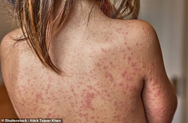 Measles Outbreak Escalates in London as Schools Consider Restrictions for Unvaccinated Children