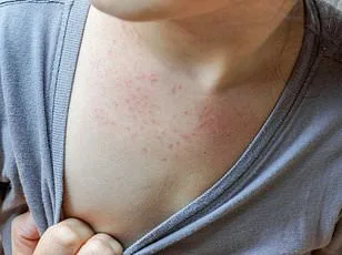 Surge in Human Metapneumovirus (HMPV) Sparks Alarms as Cases Rise to 5% of Respiratory Tests