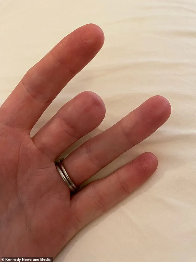 A Faint Brown Line: The Hidden Warning Sign of Aggressive Melanoma That Led to Amputation