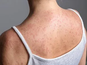 Los Angeles County Faces Record Surge in Flea-Borne Typhus Cases as Public Health Crisis Erupts