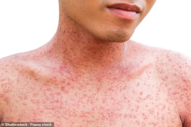 Los Angeles County Faces Record Surge in Flea-Borne Typhus Cases as Public Health Crisis Erupts
