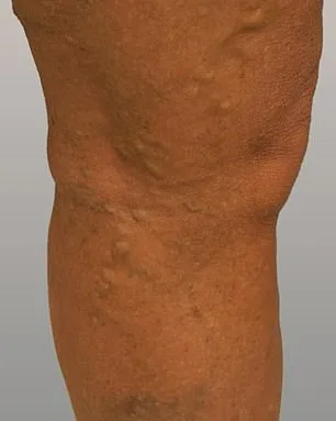 Philippa Bradley's Relentless Battle with Varicose Veins: From Silent Pain to Defying Medical Dismissal