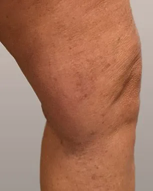 Philippa Bradley's Relentless Battle with Varicose Veins: From Silent Pain to Defying Medical Dismissal