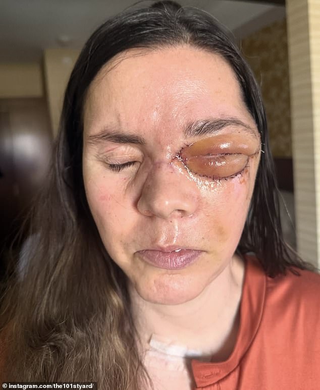 Kenai resident breaks silence on life-altering injuries from bear mauling.