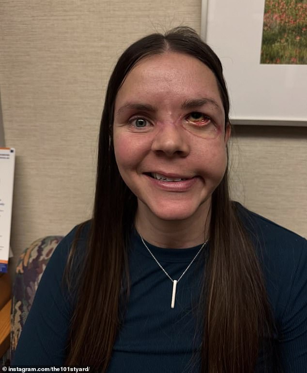 Kenai resident breaks silence on life-altering injuries from bear mauling.